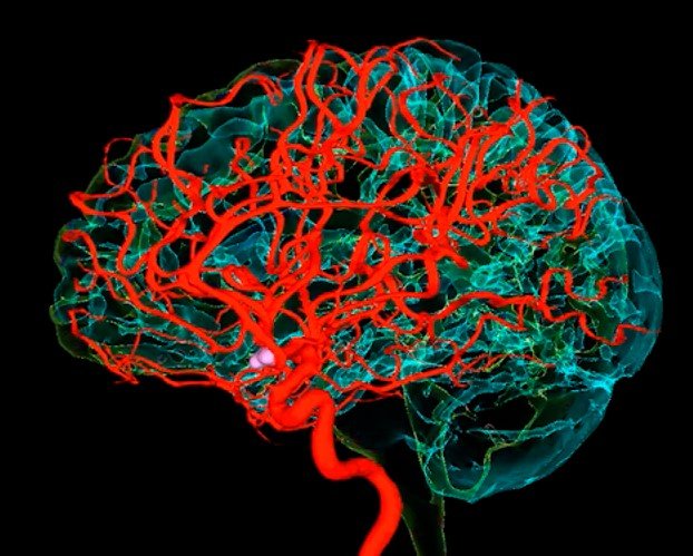 Angiographie vasculaire cérébrale